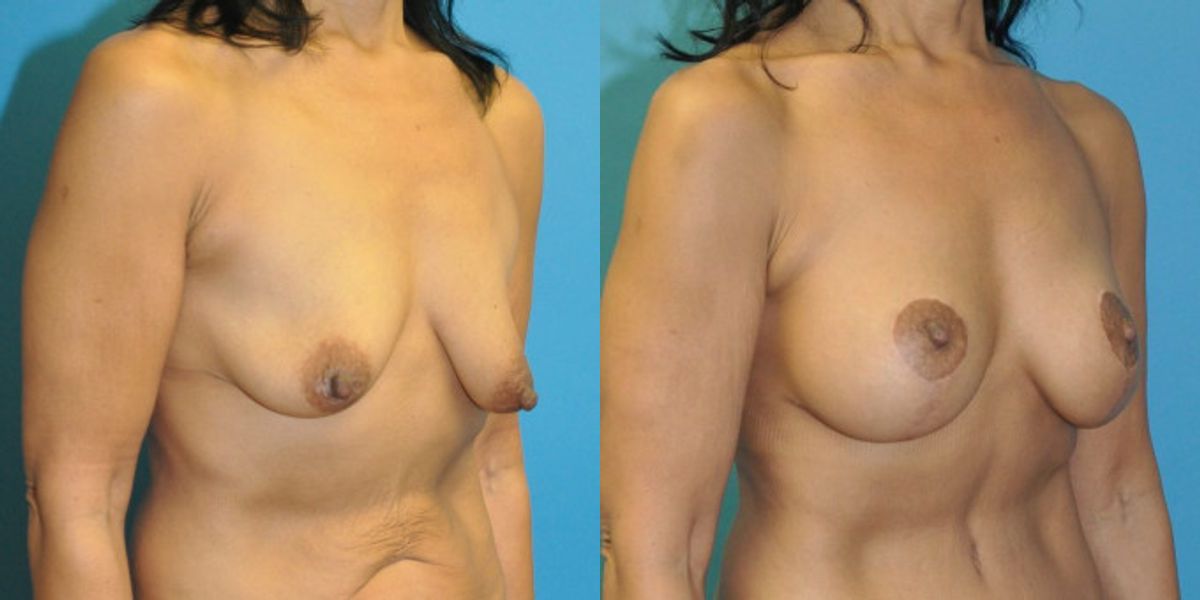 Breast Augmentation & Lift #33 - Before and After