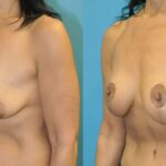 Breast Augmentation & Lift #33 - Before and After