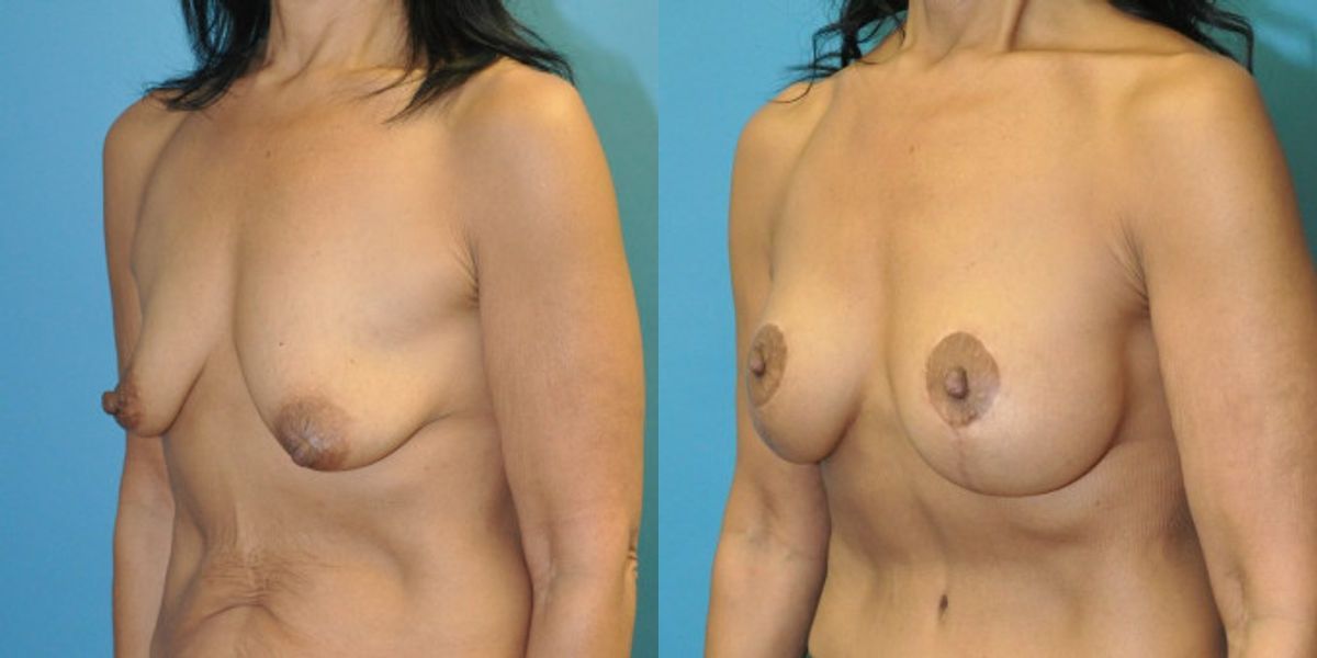 Breast Augmentation & Lift #33 - Before and After