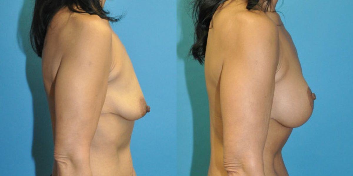 Breast Augmentation & Lift #33 - Before and After