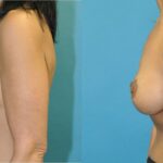 Breast Augmentation & Lift #33 - Before and After