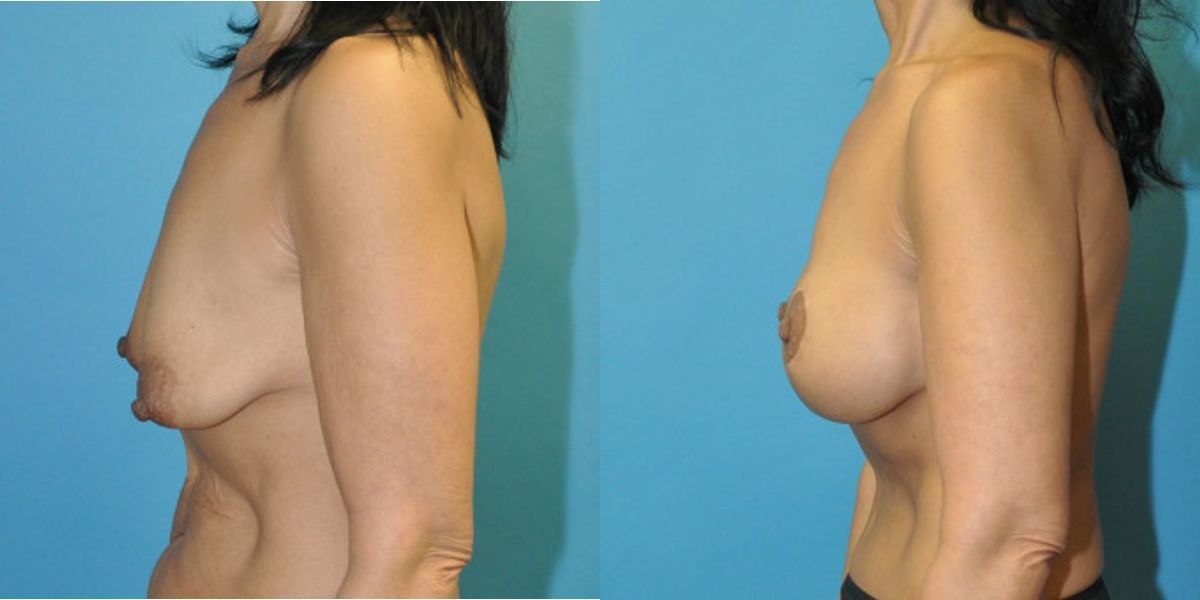 Breast Augmentation & Lift #33 - Before and After