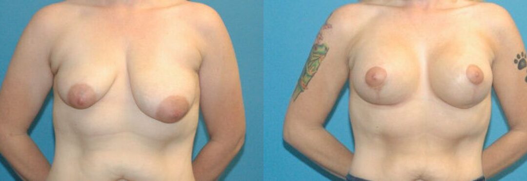 Breast Augmentation & Lift #34
