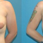 Breast Augmentation & Lift #34 - Before and After