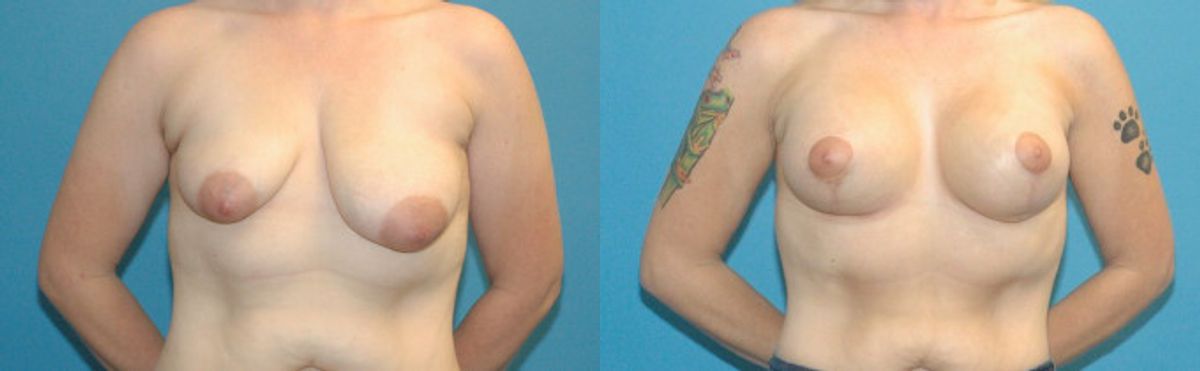 Breast Augmentation & Lift #34 - Before and After