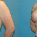 Breast Augmentation & Lift #34 - Before and After