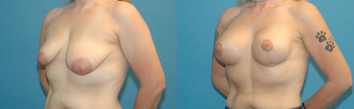 Breast Augmentation & Lift #34 - Before and After