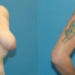 Breast Augmentation & Lift #34 - Before and After