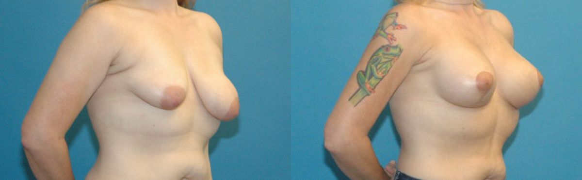 Breast Augmentation & Lift #34 - Before and After