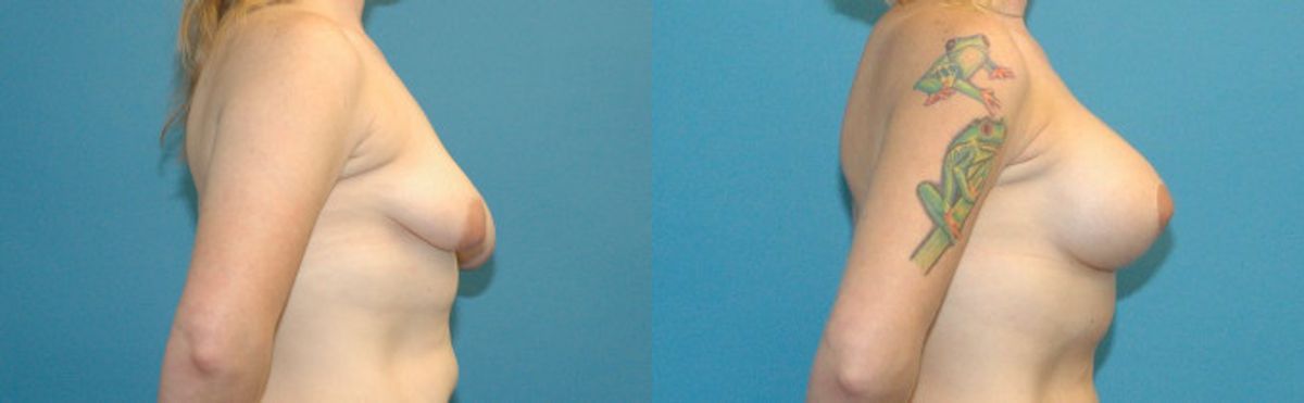 Breast Augmentation & Lift #34 - Before and After