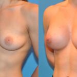 Breast Implant #1 - Before and After