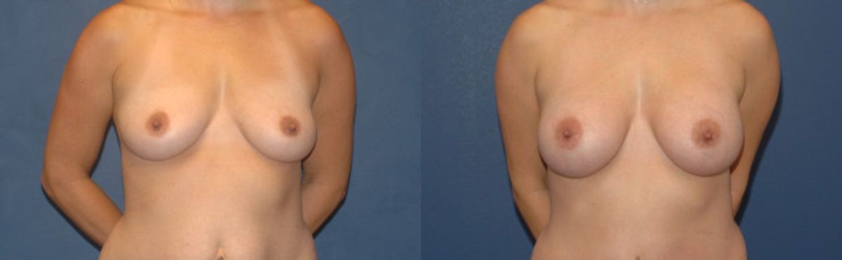 Breast Implant #2 - Before and After