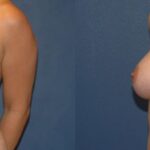 Breast Implant #2 - Before and After