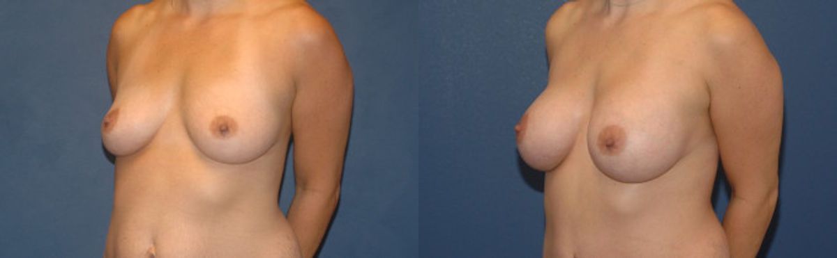 Breast Implant #2 - Before and After