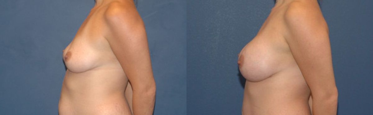 Breast Implant #2 - Before and After