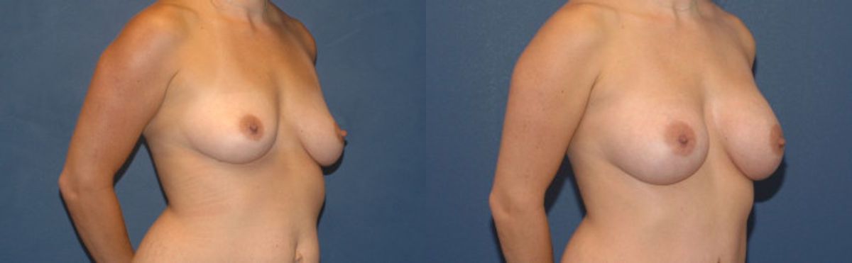 Breast Implant #2 - Before and After