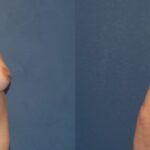 Breast Implant #2 - Before and After