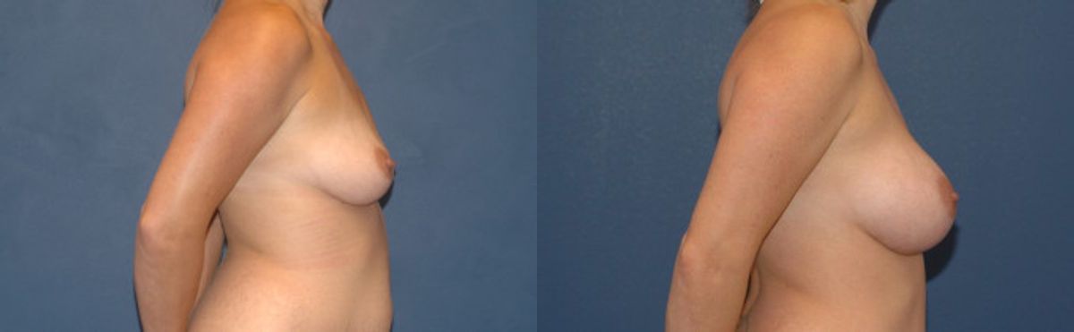 Breast Implant #2 - Before and After