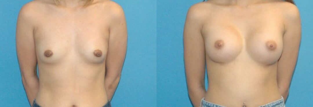 Breast Implant #3