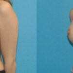 Breast Implant #3 - Before and After