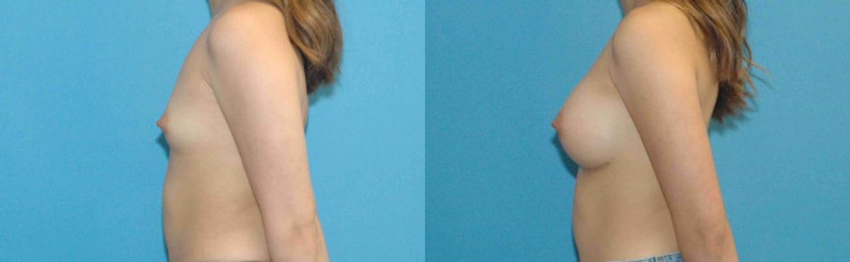 Breast Implant #3 - Before and After
