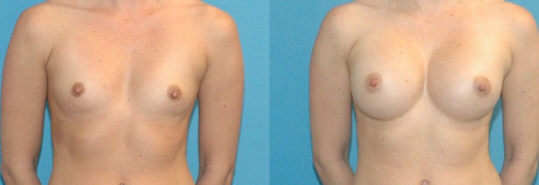 Breast Implant #4