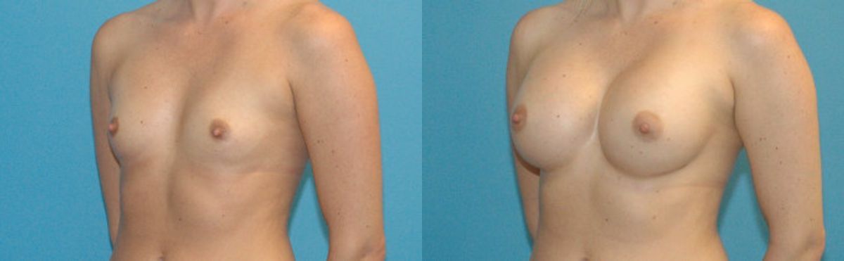 Breast Implant #4 - Before and After