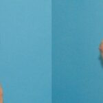 Breast Implant #4 - Before and After