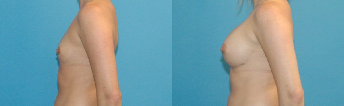 Breast Implant #4 - Before and After