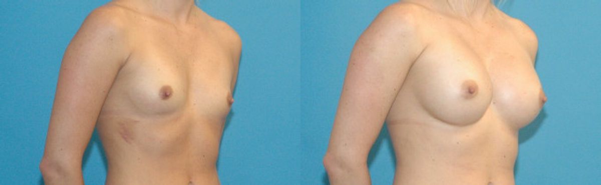 Breast Implant #4 - Before and After