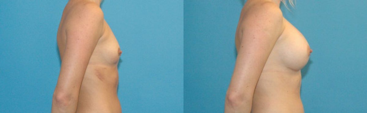 Breast Implant #4 - Before and After