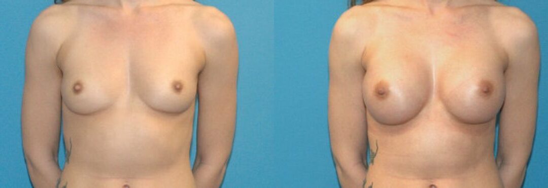 Breast Implant #5