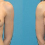 Breast Implant #5 - Before and After
