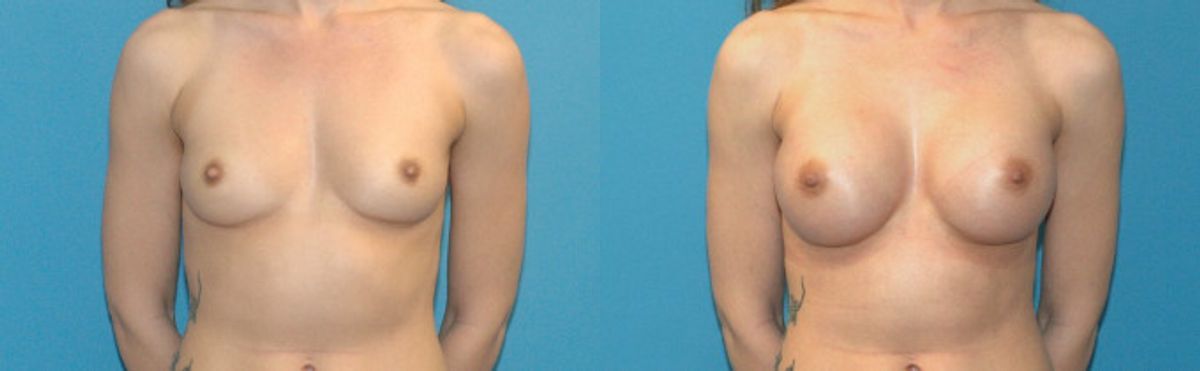 Breast Implant #5 - Before and After
