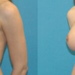 Breast Implant #5 - Before and After