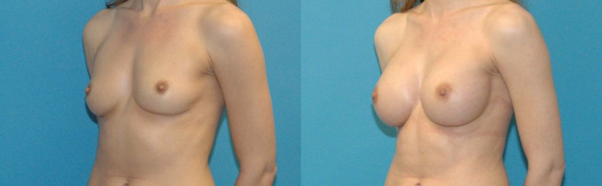 Breast Implant #5 - Before and After