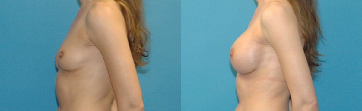 Breast Implant #5 - Before and After