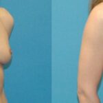 Breast Implant #5 - Before and After