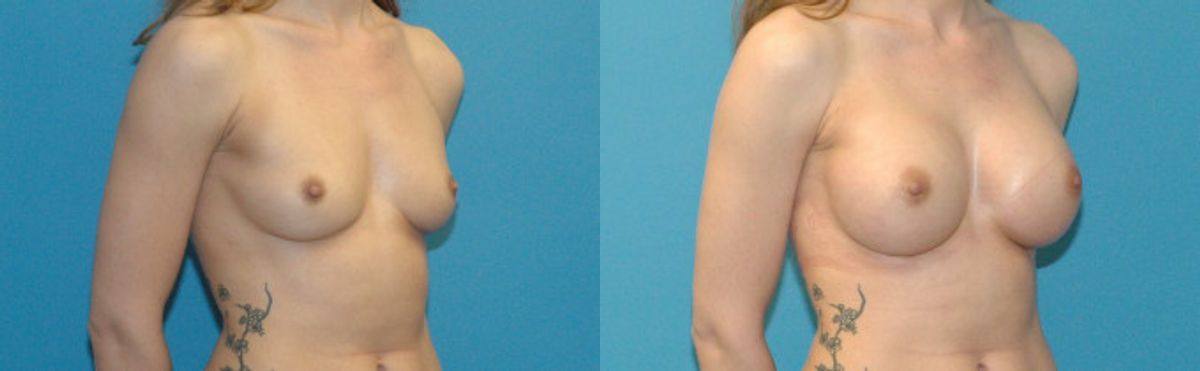 Breast Implant #5 - Before and After