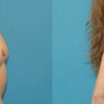 Breast Implant #5 - Before and After