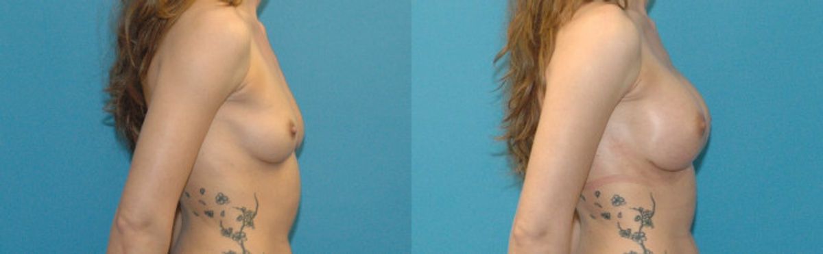 Breast Implant #5 - Before and After