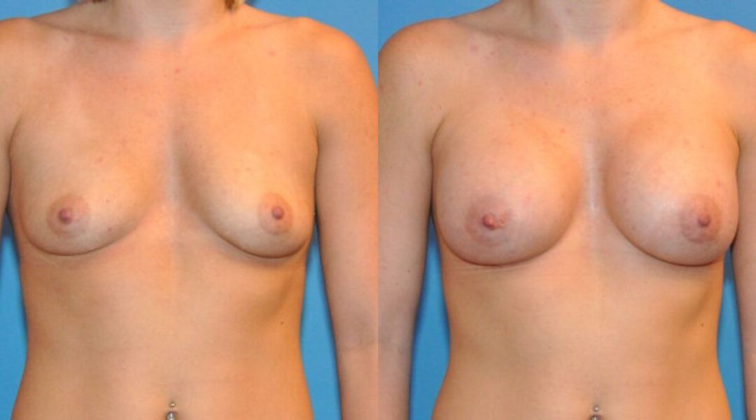 Breast Implant #6