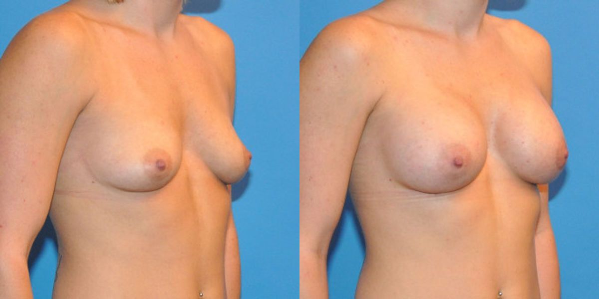 Breast Implant #6 - Before and After