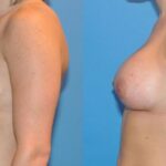 Breast Implant #6 - Before and After