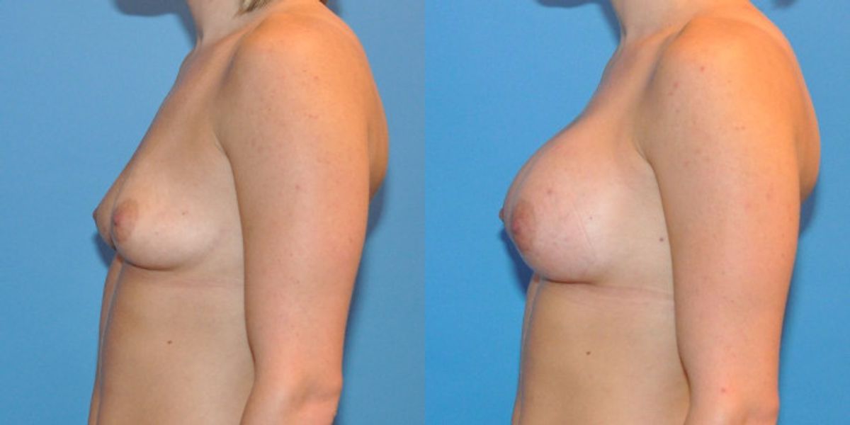 Breast Implant #6 - Before and After