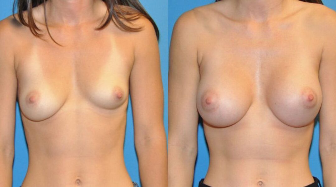 Breast Implant #7