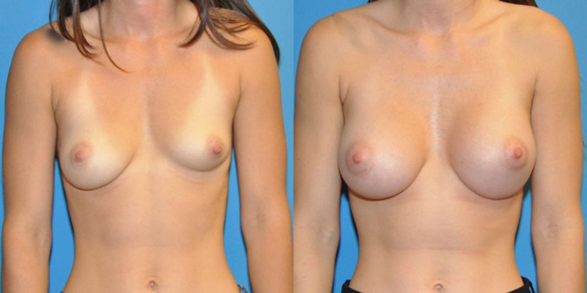 Breast Implant #7 - Before and After