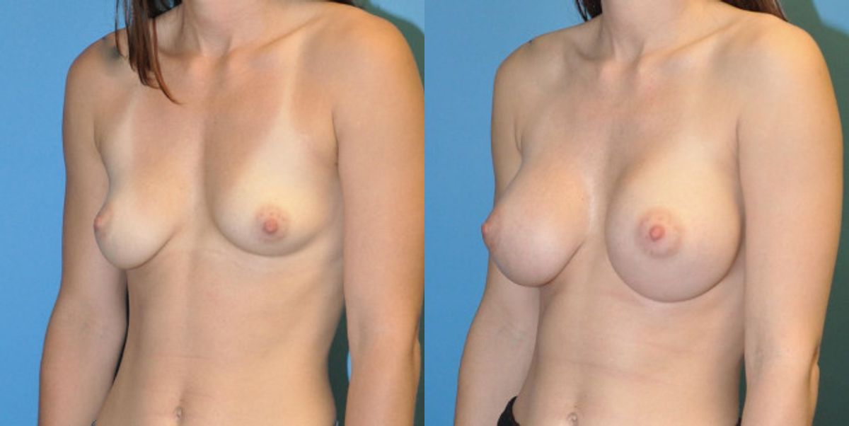 Breast Implant #7 - Before and After