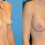 Breast Implant #7 - Before and After