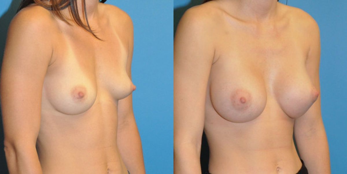 Breast Implant #7 - Before and After